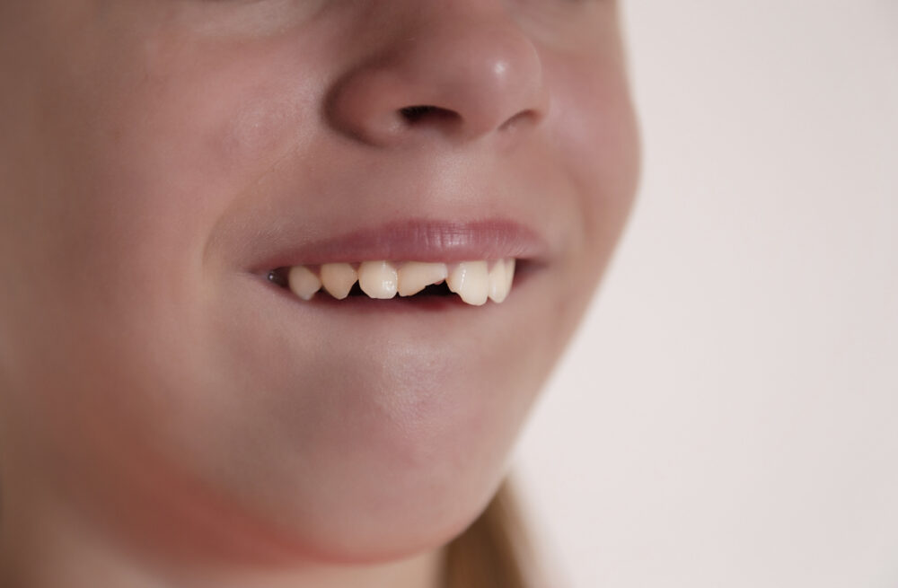 Handling a Chipped Tooth in a Child