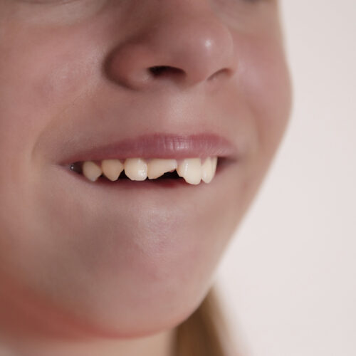 Handling a Chipped Tooth in a Child